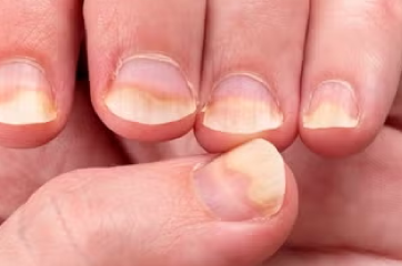 Doenças das Unhas