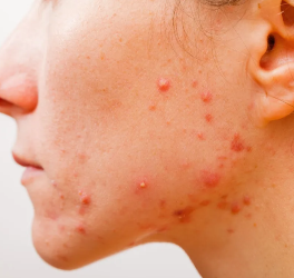Acne