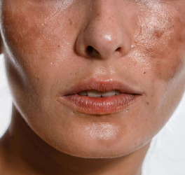 Melasma